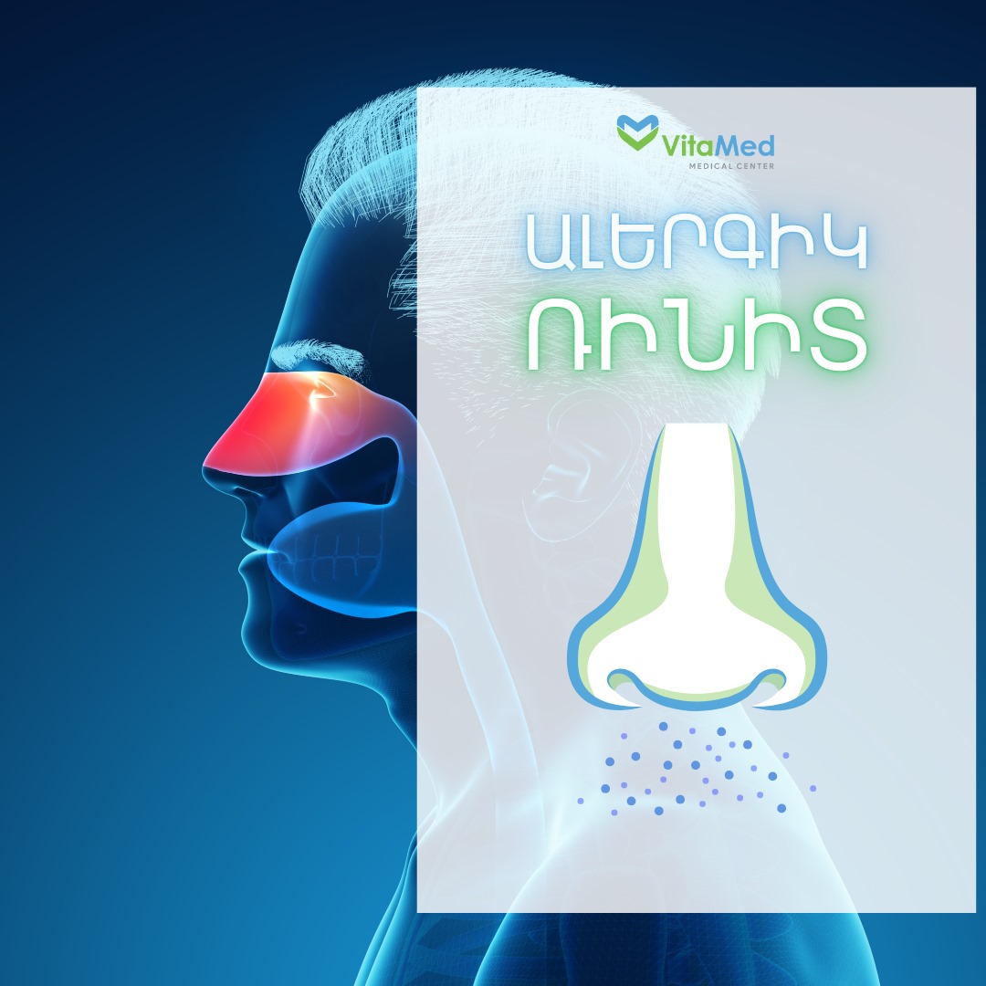 ԱԼԵՐԳԻԿ ՌԻՆԻՏ. ԱՌԱՋԱՑՄԱՆ ՊԱՏՃԱՌՆԵՐԸ, ԱԽՏՈՐՈՇՈՒՄԸ, ԲՈՒԺՈՒՄԸ