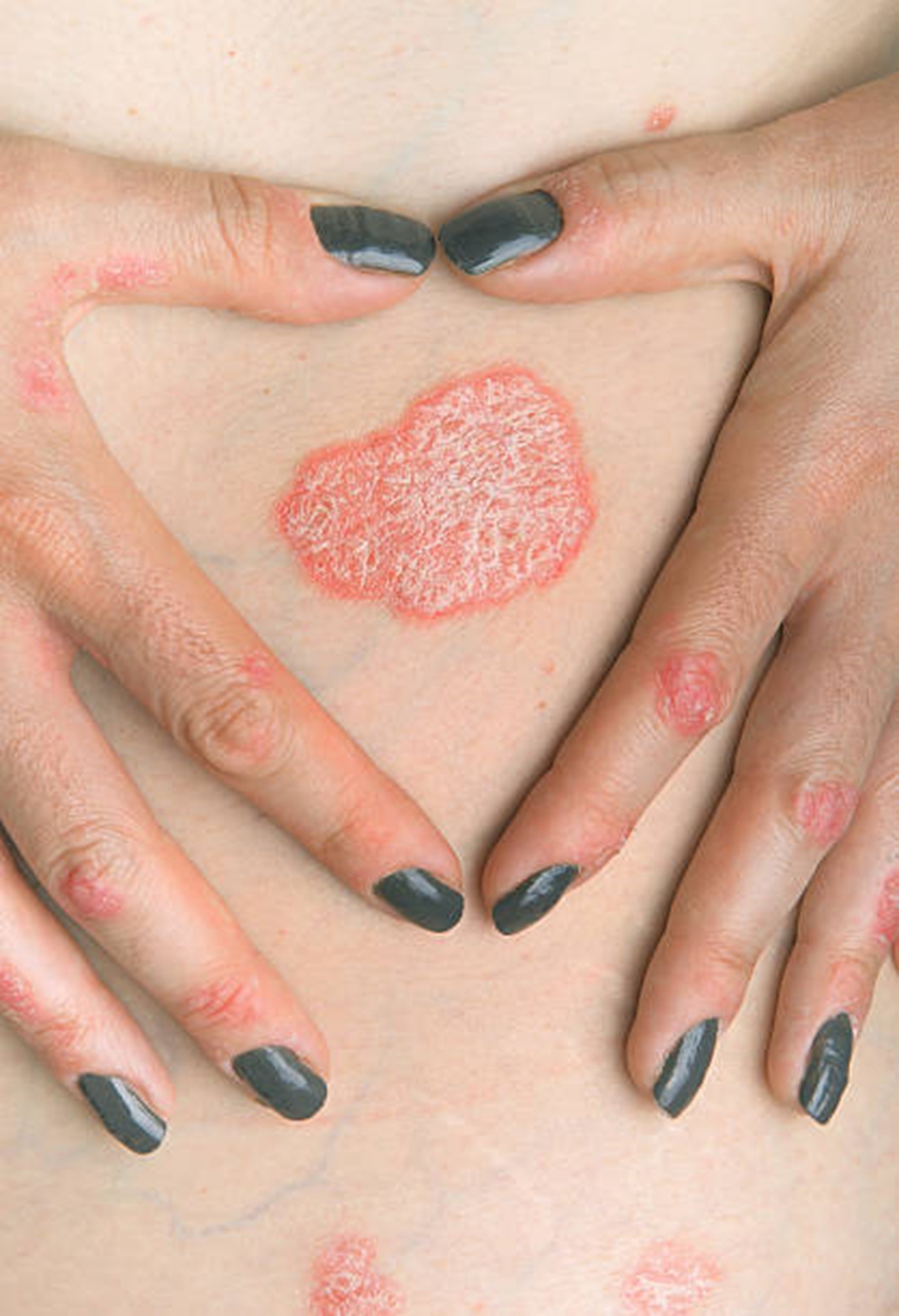 PSORIASIS